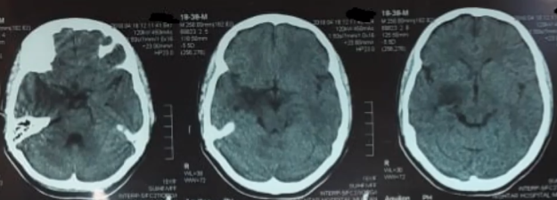 mesial temporal glioma